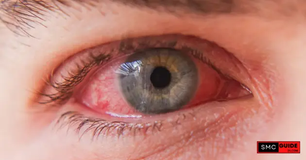 Conjunctivitis or Pink Eye.